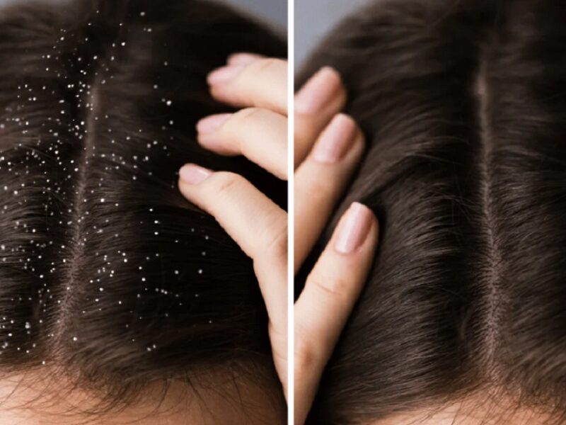 Dandruff Removal Tips