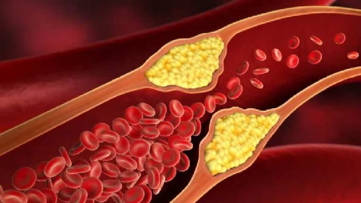 How To Lower LDL Cholesterol