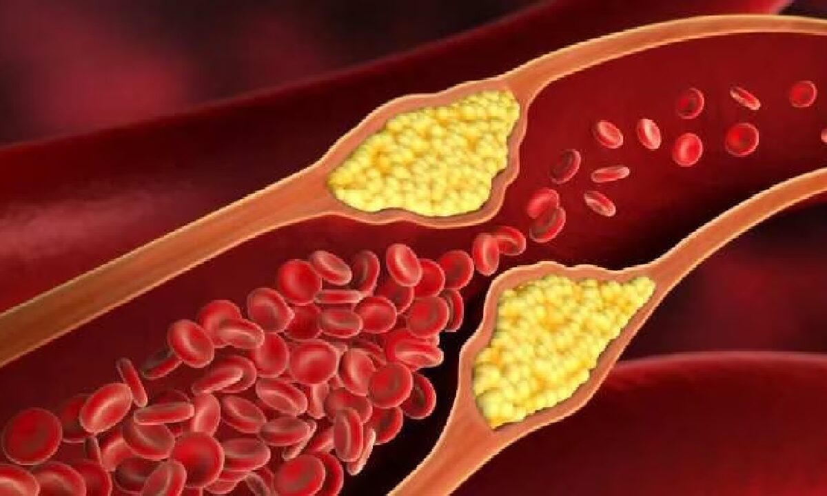 How To Lower LDL Cholesterol