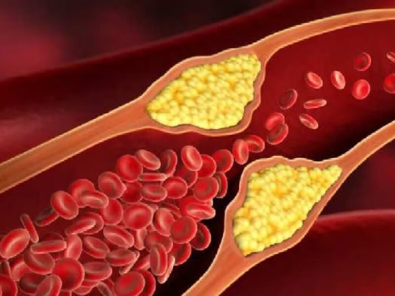 How To Lower LDL Cholesterol