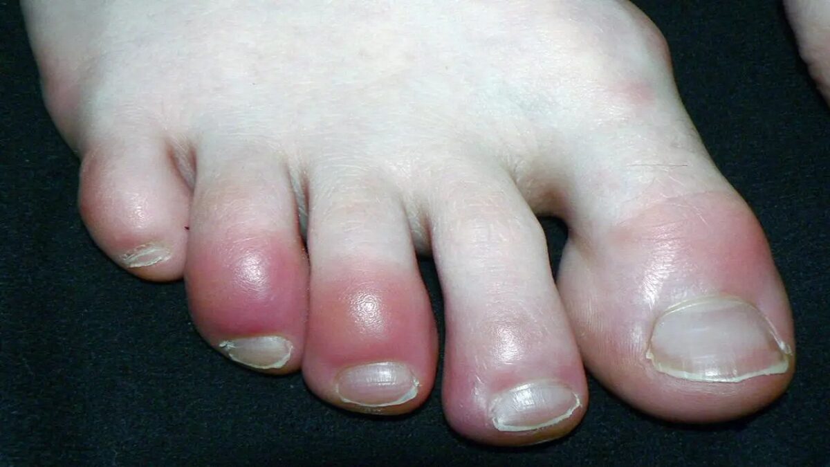 Swelling toes