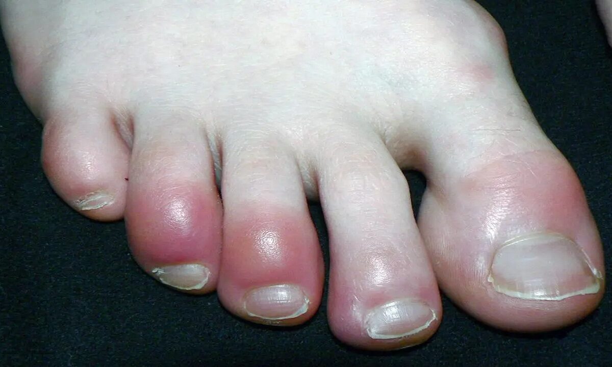 Swelling toes