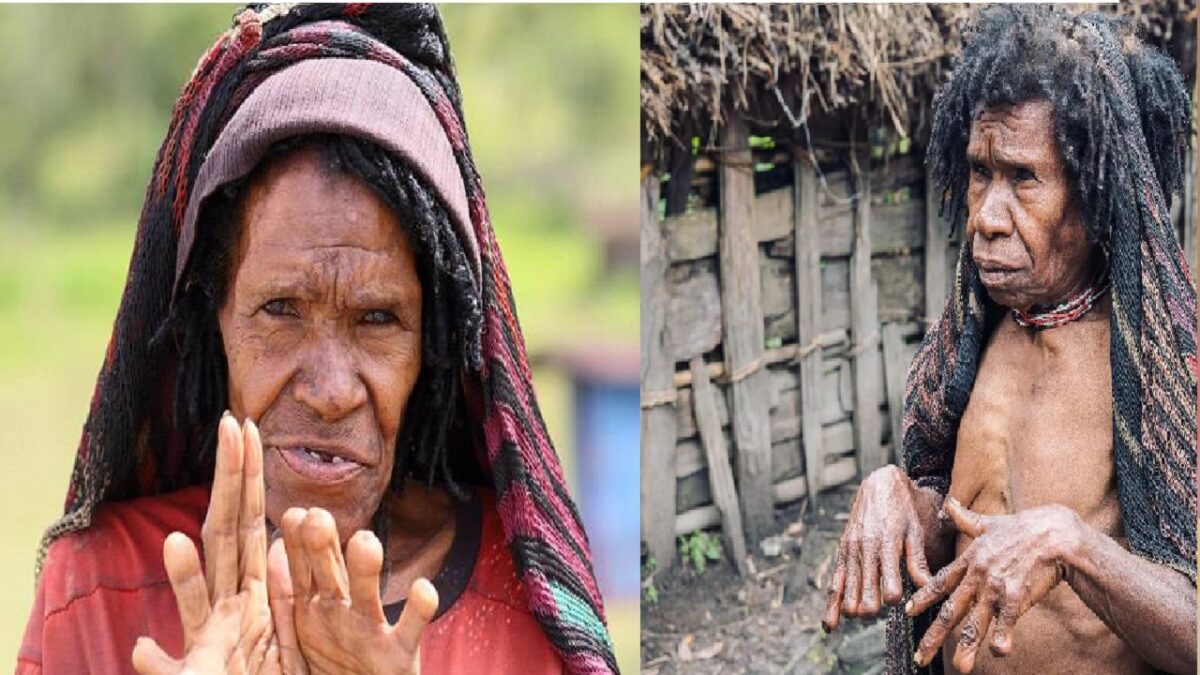 Indonesia Womans Finger Is Cut