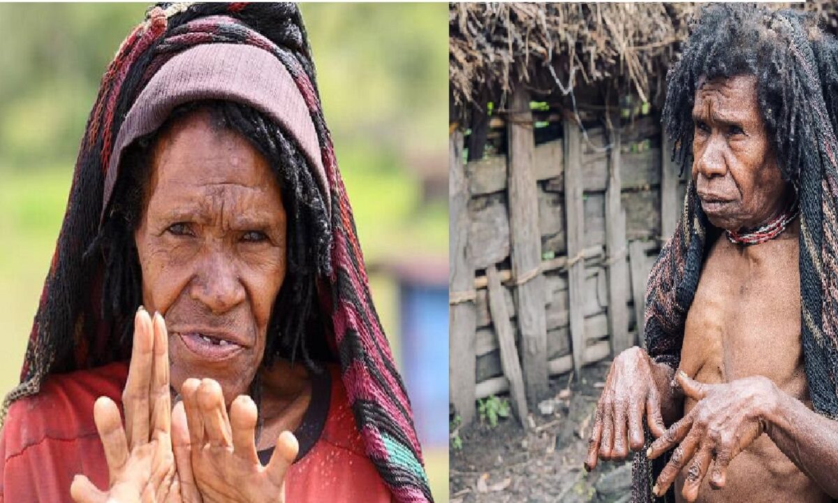 Indonesia Womans Finger Is Cut