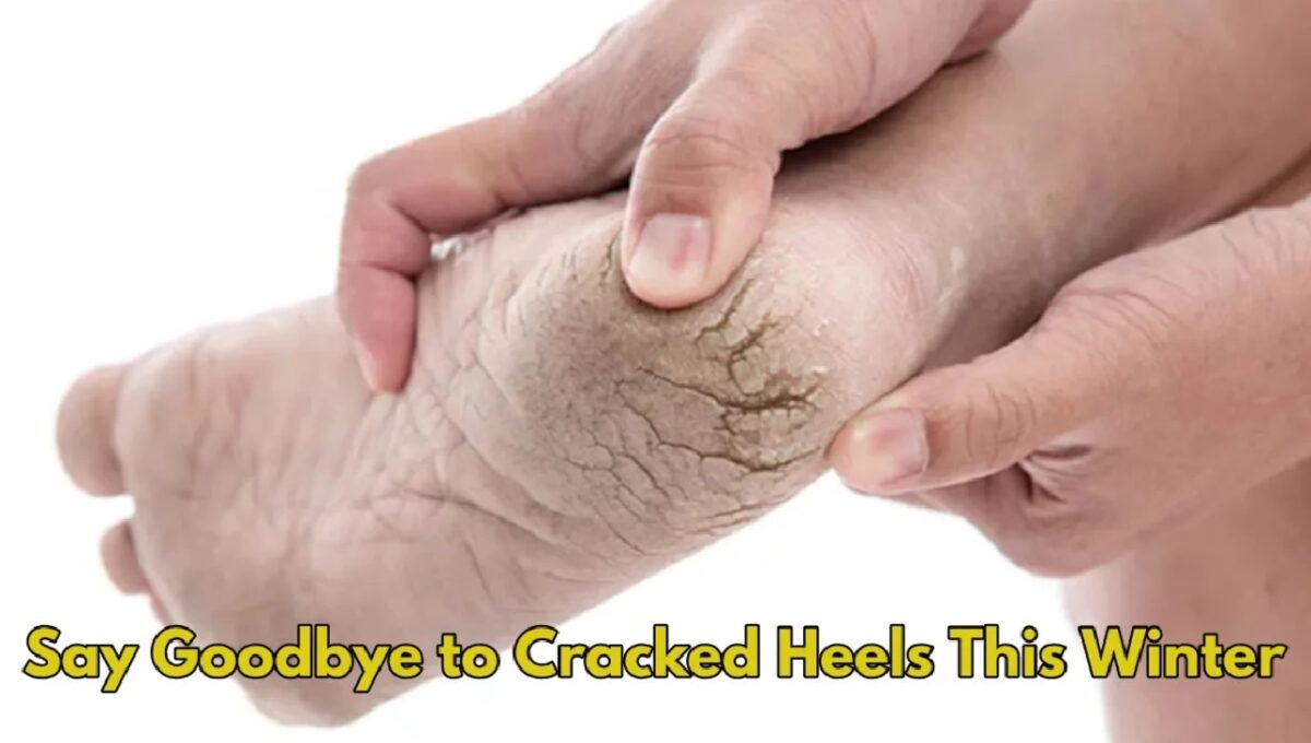 Cracked Heels