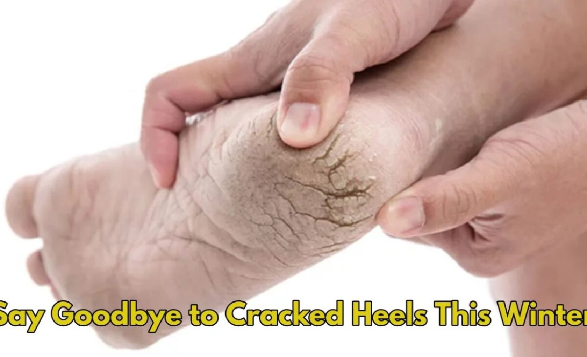 Cracked Heels